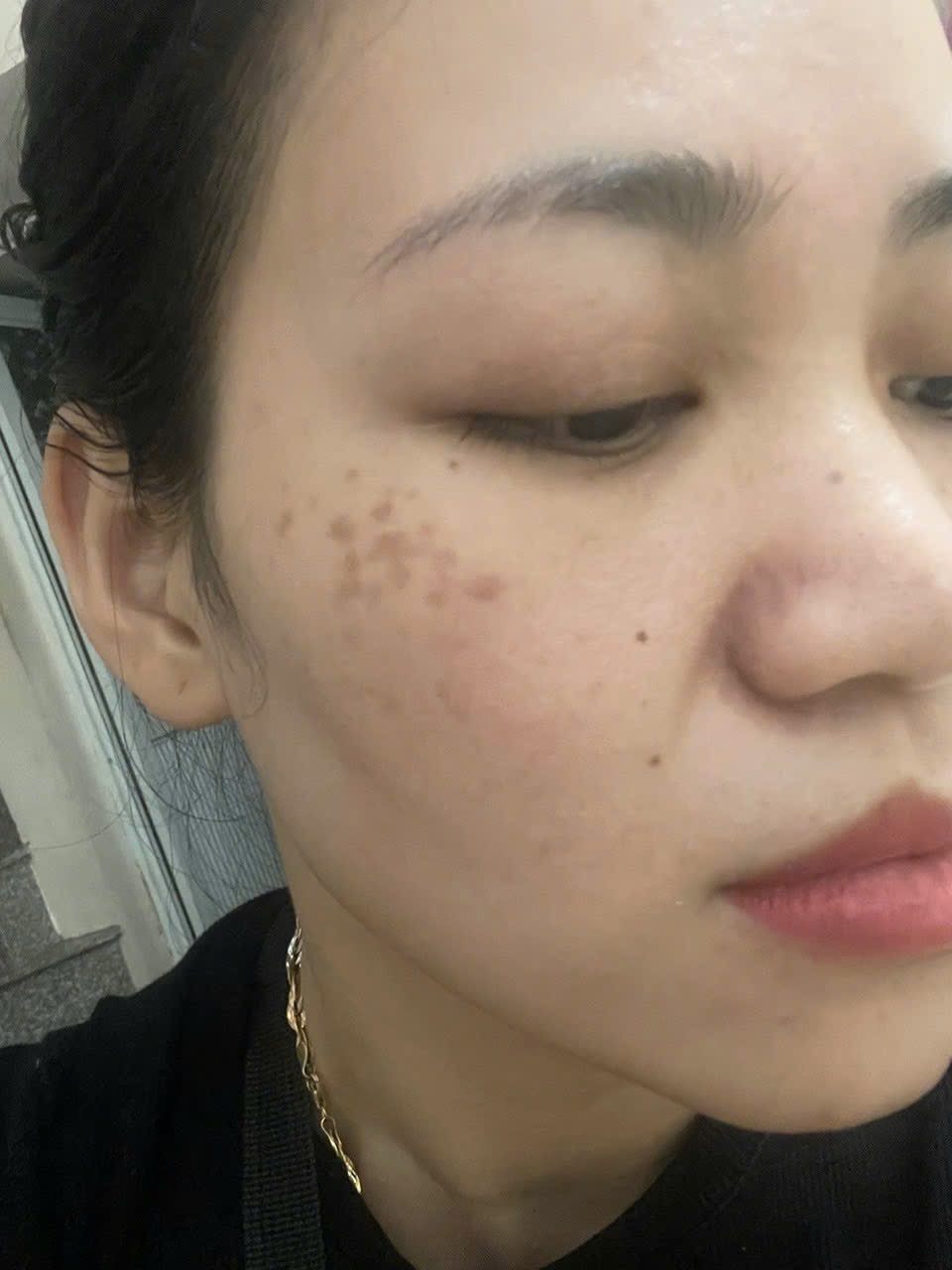 Cấp ẩm và HA cho da dầu